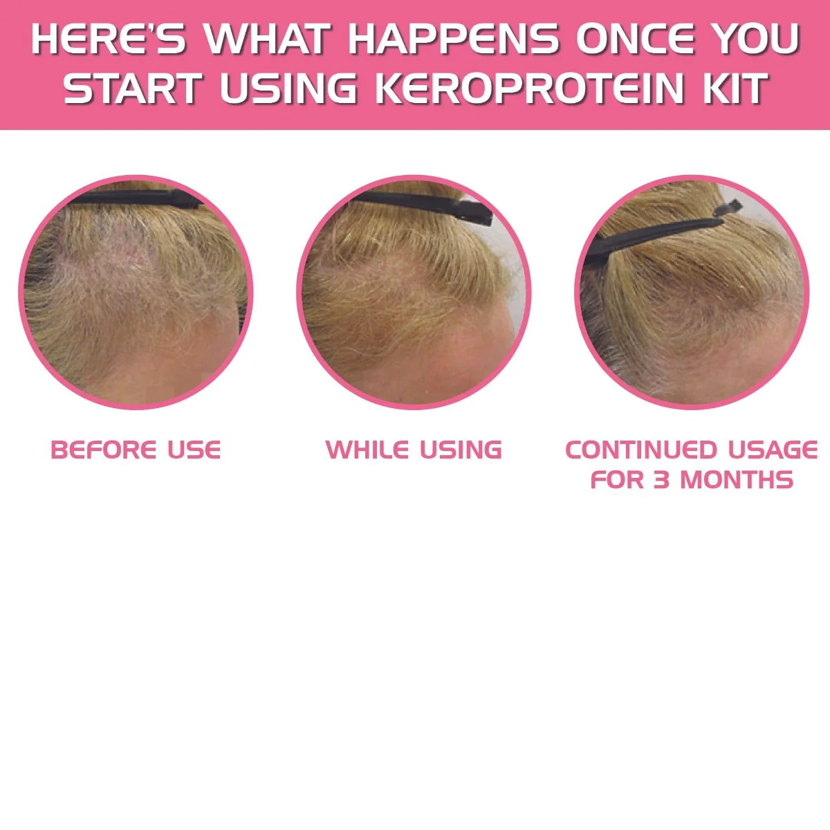 YogaManLab® KEROPROTEIN Plant Hair Growth Therapy Kit (Women) | Includes Topical Hair Growth Oil (30ml) + Keroneedle (0.5mm) - Image 10