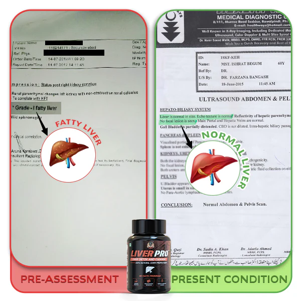 YogaManLab® Liver Pro - Fatty Liver Ayurvedic Supplement | Helps Restore Liver Health & Remove Toxins | 100% Natural & Ayurvedic | 28 Days Program - Image 12