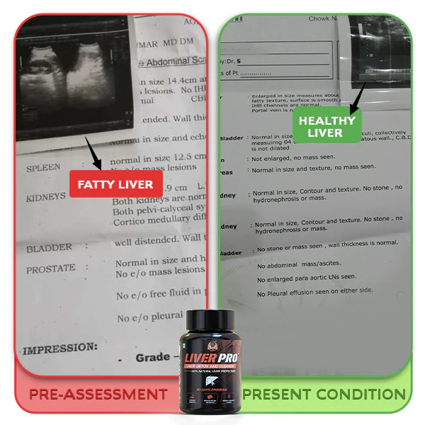 YogaManLab® Liver Pro - Fatty Liver Ayurvedic Supplement | Helps Restore Liver Health & Remove Toxins | 100% Natural & Ayurvedic | 28 Days Program - Image 13