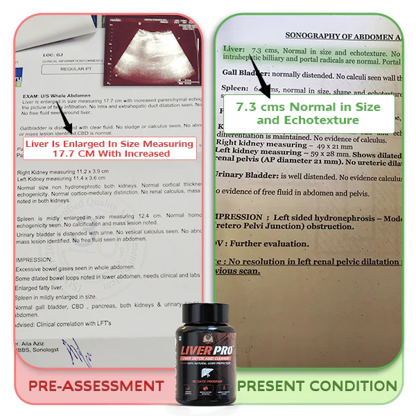 YogaManLab® Liver Pro - Fatty Liver Ayurvedic Supplement | Helps Restore Liver Health & Remove Toxins | 100% Natural & Ayurvedic | 28 Days Program - Image 16